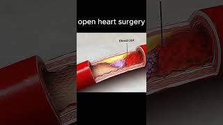 What happens during open heart surgery? 😨 #doctor #medical