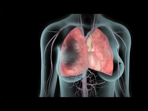 Видео: Что такое острая тромбоэмболия легочной артерии?