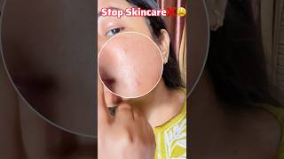 Maine Skincare chor diya😩😭#skincare #skincaremistakes #acnetreatment #darkspots