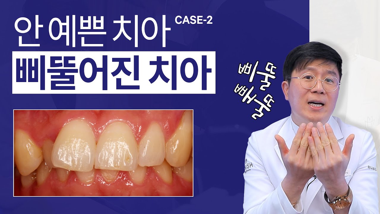 [안 예쁜 치아 2] 삐뚤빼뚤 겹쳐진 치아｜건강하고 아름답게 미니쉬