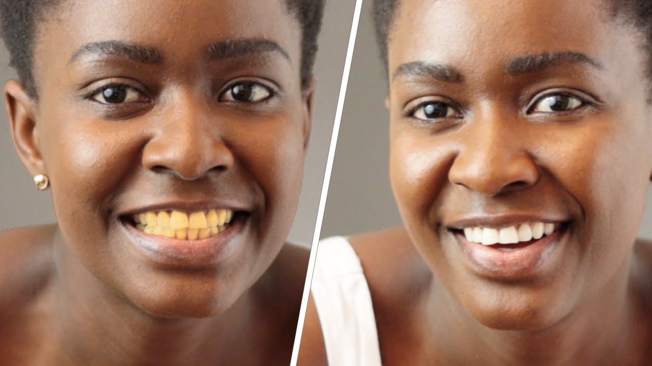 HOW I WHITEN MY YELLOW TEETH NATURALLY AND NSTANT AT HOME IN JUST 2 ...