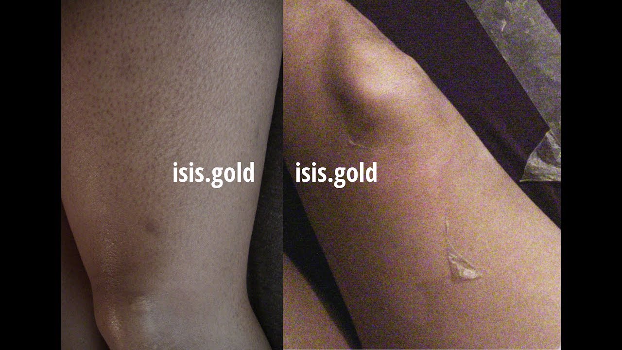 Cure Keratosis Pilaris {Saliclear body peel} YouTube