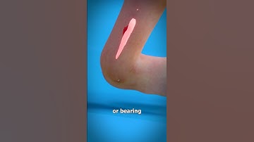 Thumbnail of Sprained Ankle 😫 (explained)