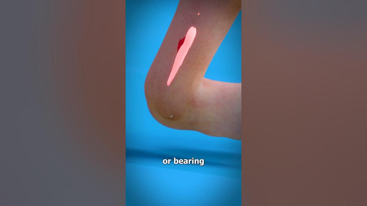 Sprained Ankle 😫 (explained)