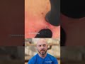 Giant Neck Cyst or Blackhead? Large Extraction on the Upper Back