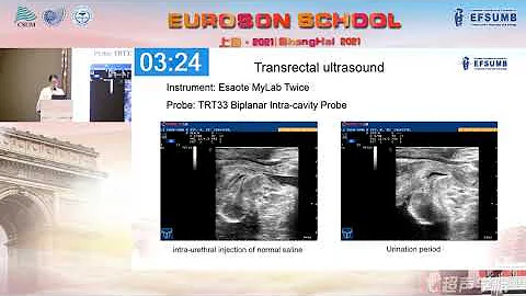 EUROSON SCHOOL ShangHai 30th July 2021 Afternoon Case: 郭倩 何方神聖，報上名來——盆腔佔位一例超聲造影分析 - 天天要聞