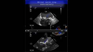 Mitral valve ring annuloplasty #echocardiography #cardiologytraining