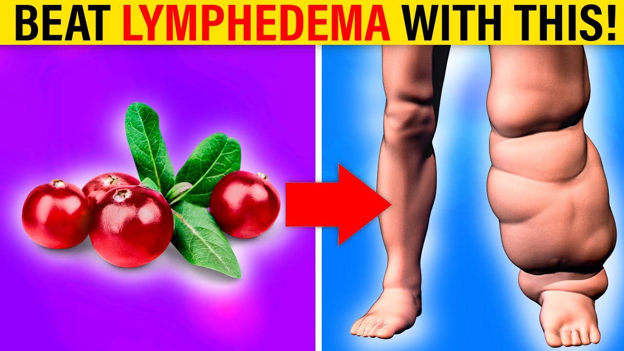 LYMPHEDEMA SUCKS! 5 Unique And Natural Ways To Manage Effectively