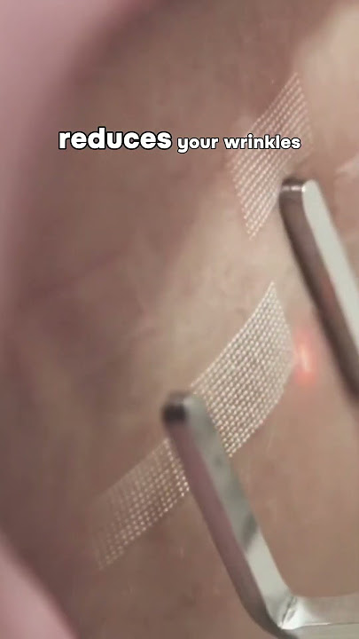 DEEP Acne Scars: CO2 Laser
