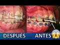 ¿Como mejorar dientes proinclinados,  sin  la extracción de dientes premolares en algunos casos?😎✌