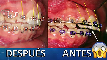 ¿Cómo arreglar dientes inclinados?