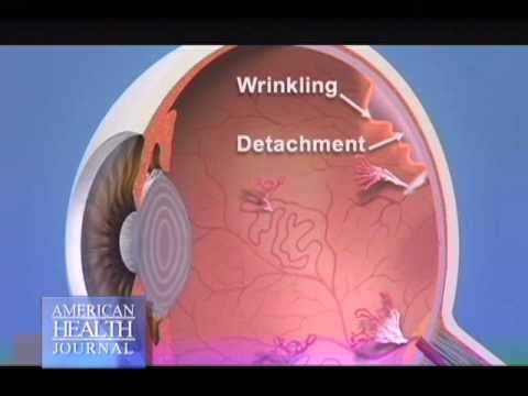 how-does-diabetes-affect-the-eyes---david-boyer-md