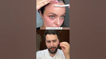 حلاقة شعر الوجه بالشفرة دكتور يوسف 