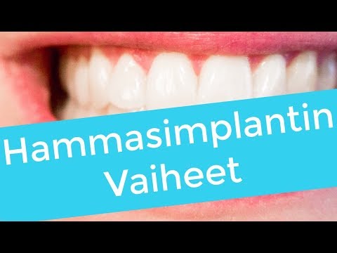 Video: Hammasproteesit Tai Implantointi?