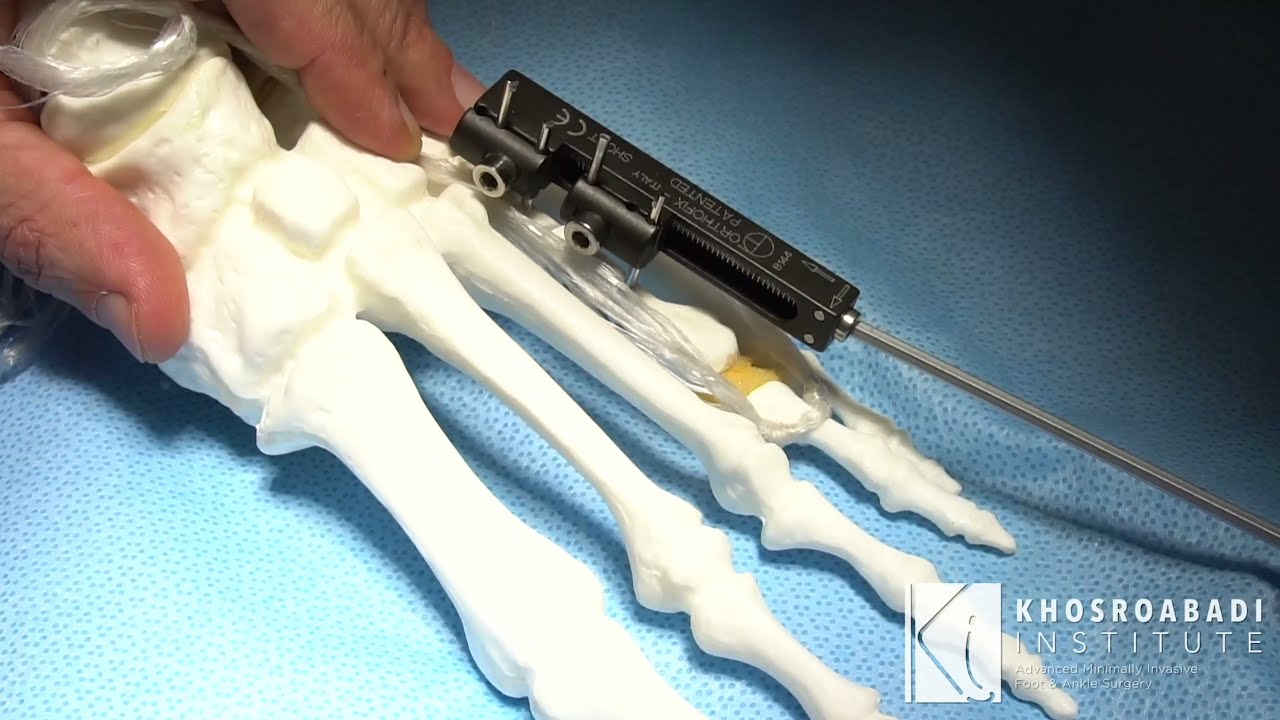 Metatarsal Lengthening: Understanding Complications | Part 2 | Brachymetatarsia