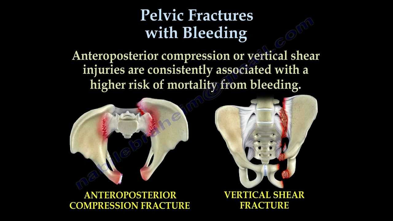 Pelvic Fractures - Trauma - Harwood-Nuss' Clinical Practice of Emergency  Medicine, 6 ed.