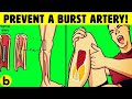 How To Prevent Blood Clots And Stop A Bursting Artery