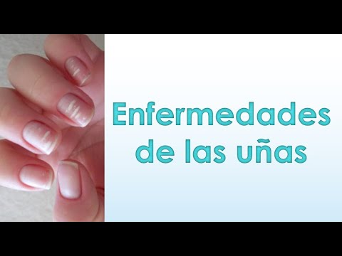 Vídeo: Anormalidades En Las Uñas: Síntomas, Causas Y Prevención