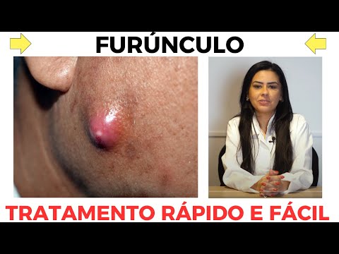 TRATAMENTO CASEIRO PARA FÚRUNCULO [CONHEÇA AGORA]