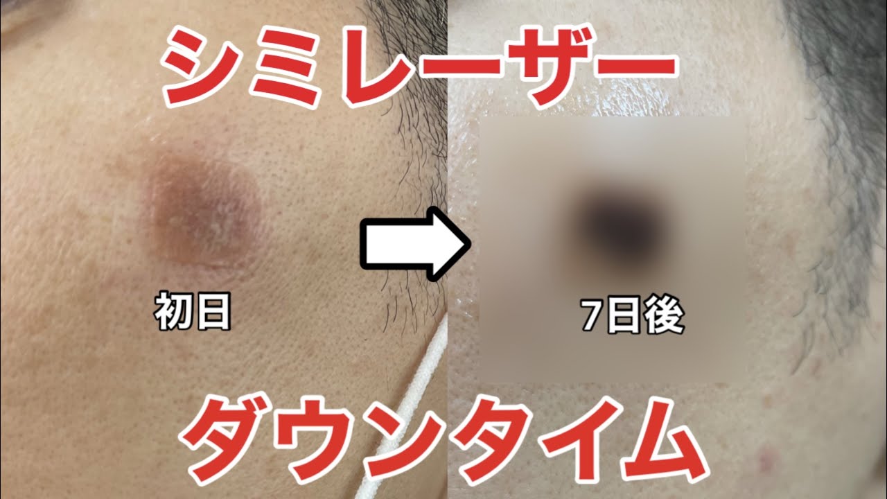 湘南美容クリニックでシミ取りレーザー ダウンタイムは結構グロいです たきlogg