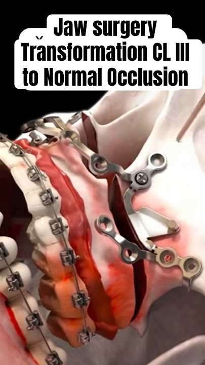 Jaw surgery big Transformation CL III to normal Bite