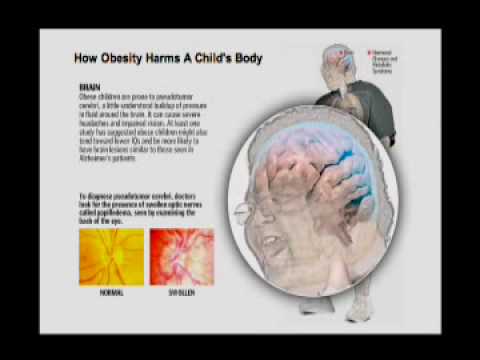 Western Baptist: Withrow on Childhood Obesity -- P...