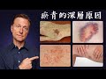 瘀青的深層原因 未受傷的瘀青 維生素K1K2自然療法 柏格醫生 Dr Berg 瘀青的深層原因 未受傷的瘀青 維生素K1K2自然療法 柏格醫生 Dr Berg