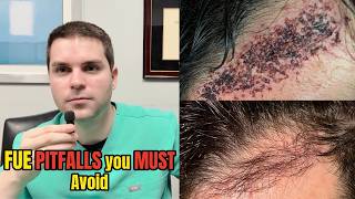 FUE Hair Transplant Pitfalls You MUST Avoid | Dr. Shane Boucher | NY, NYC, Long Island