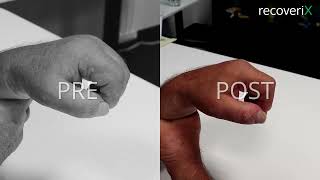 Before/After recoveriX - stroke - WDF WPF - ST4
recoveriX is measuring EEG activity while a patient imagines a hand or foot movements. Once recoveriX detects a motor imagination, it triggers a functional electrical stimulation of the limb so that the limb performs a real movement. Here you can see the improvement in the hand movement of the stroke-affected hand.
Learn more about this treatment: https://recoverix.com/ Before/After recoveriX - stroke - WDF WPF - ST4