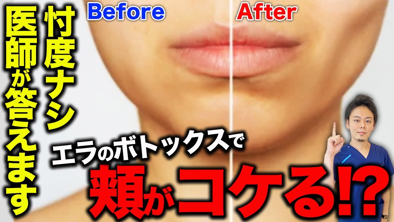 エラにボトックスを打つと頬はコケるの？正しいボトックスの打ち方を医師が解説！ - YouTube