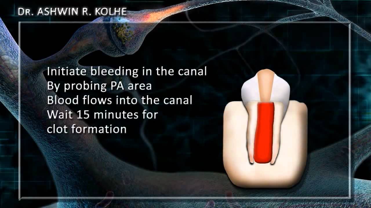 Apical Regeneration& Revascularization. YouTube