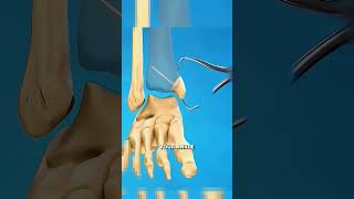 Do You Need Surgery for a Medial Malleolus Ankle Fracture?