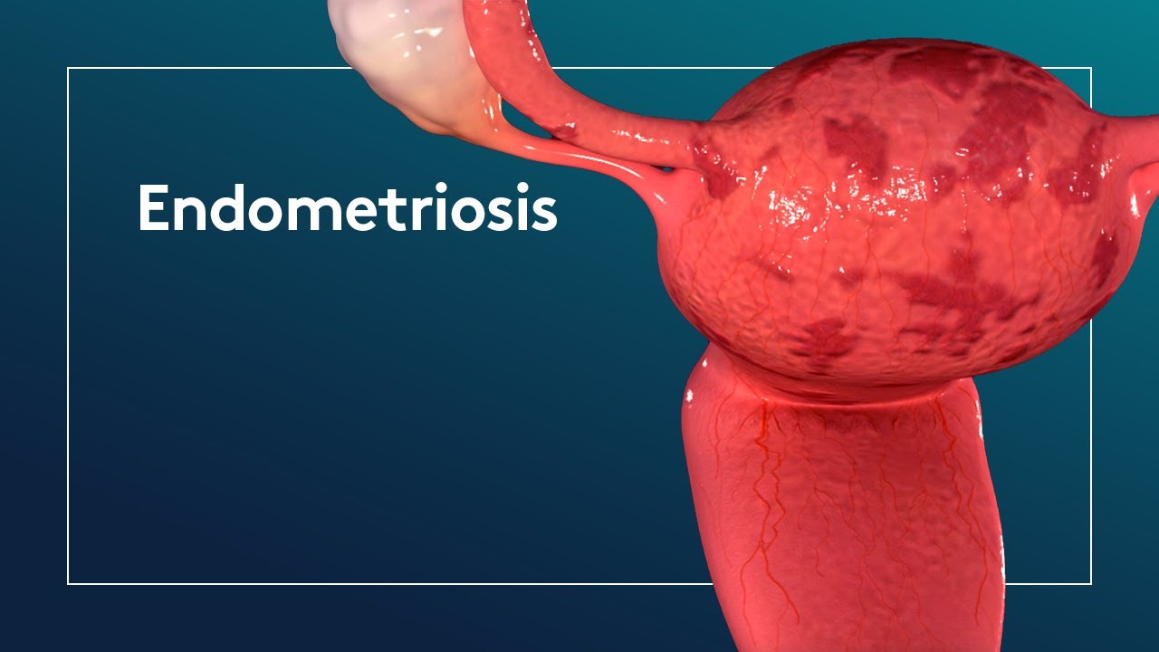 Endometritis cronica sintomas