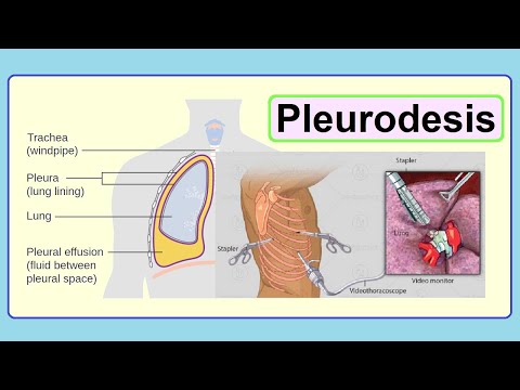 Video: Pleurodesis inamaanisha nini?