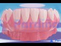 ओवरडेन्चर (overdenture) ©