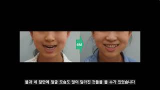 위아래 앞니가 안물리는 심한 개방교합 치료사례