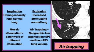 Air Trapping radiology pulmonology asthma