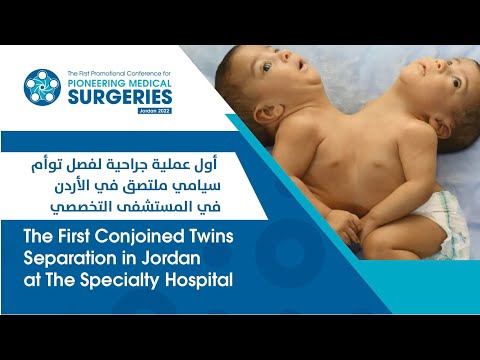 فيديو أول عملية جراحية لفصل توأم سيامي ملتصق في الأردن بقيادة الدكتور فوزي الحموري رئيس الفريق