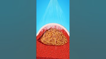 Học và Hỏi - Cách tốt nhất để loại bỏ mụn cóc  #xuhuong #khampha #kienthucthuvi #cothebanchuabiet