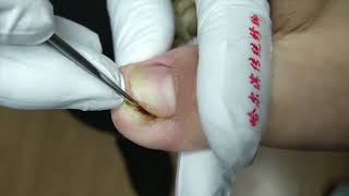 Serious Ingrown toenail digging by BABI TOYS 73 views 3 years ago 39 seconds