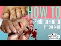 👣HOW TO DO A PEDICURE on a Pincer Toenail👣