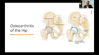 Celebrity Hip & Knee Replacements: Expert Insights from Sentara’s OrthoJoint Center Profile