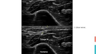 Ulnar nerve block Elbow
