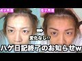 【ハゲ日記】AGA薄毛治療５ヶ月目！