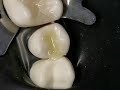 Composite Restoration Class 1 Upper Premolar Composite Restoration Class 1 Upper Premolar
