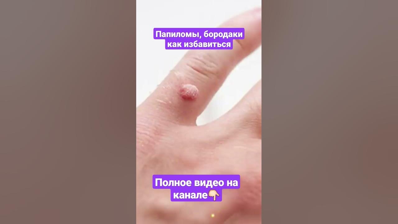 Папилломы бородавки как избавиться #здоровье #питание #пп #бородавки # ...
