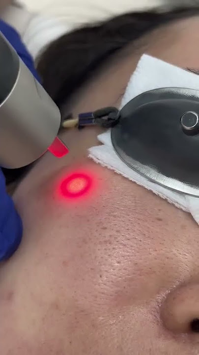 Picosure Laser untuk menghilangkan bekas luka dan pigmentasi #memuaskan #perawatankulit #antipenuaan #perawatanlaser