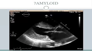 Cardiomyopathy by Dr. Sameer Shrivastava sir