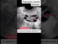 Polycystic Ovarian Disease: Symptoms and Solutions