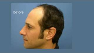 Dallas Hair Transplant - 1.800.859.2266